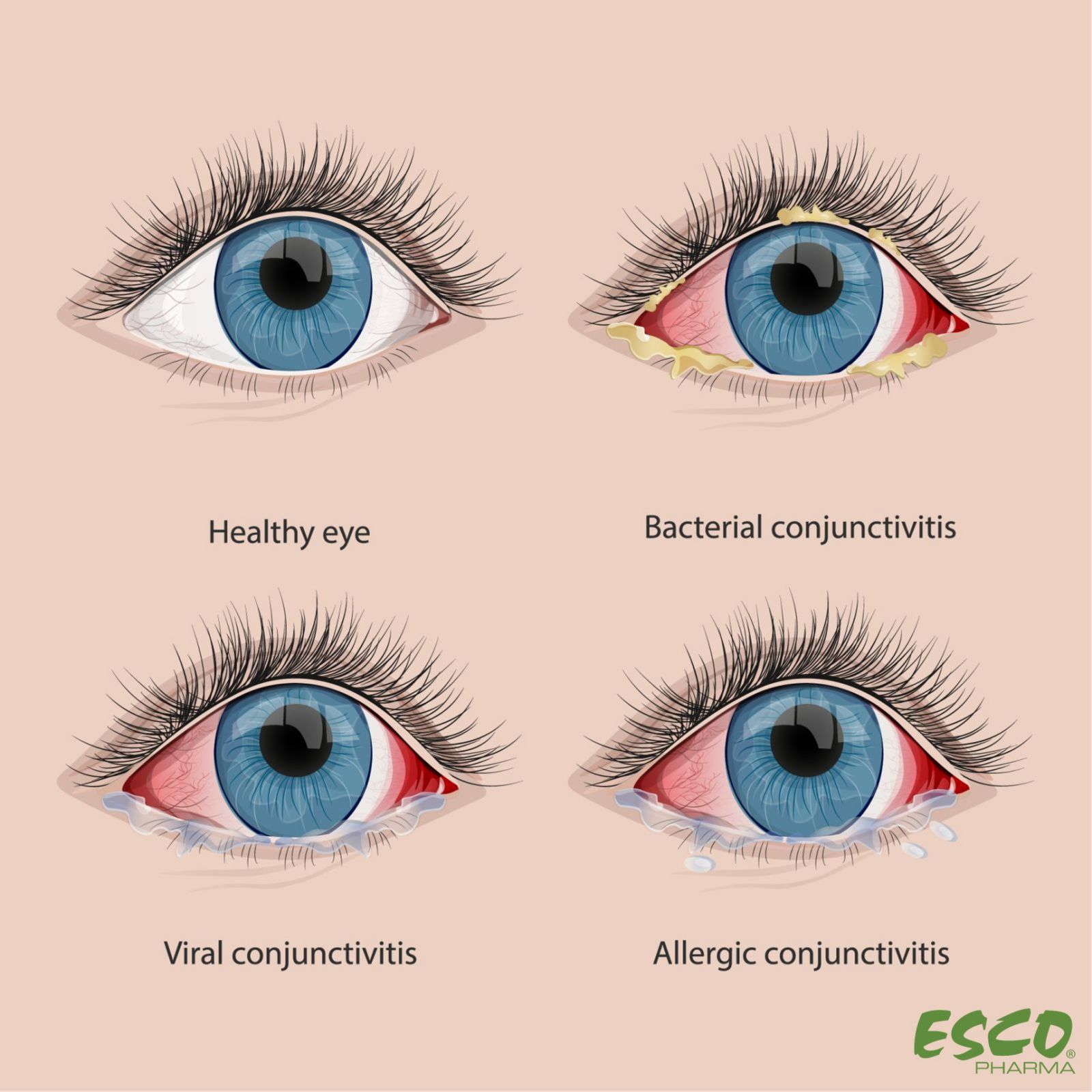 Fig. 1 Comparison of Healthy Eyes and Conjunctivitis